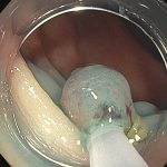 A serrated polyp is removed.