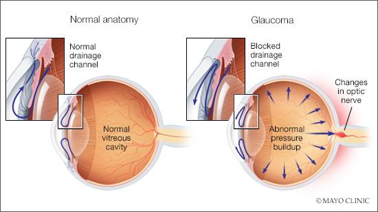 a medical illustration of glaucoma