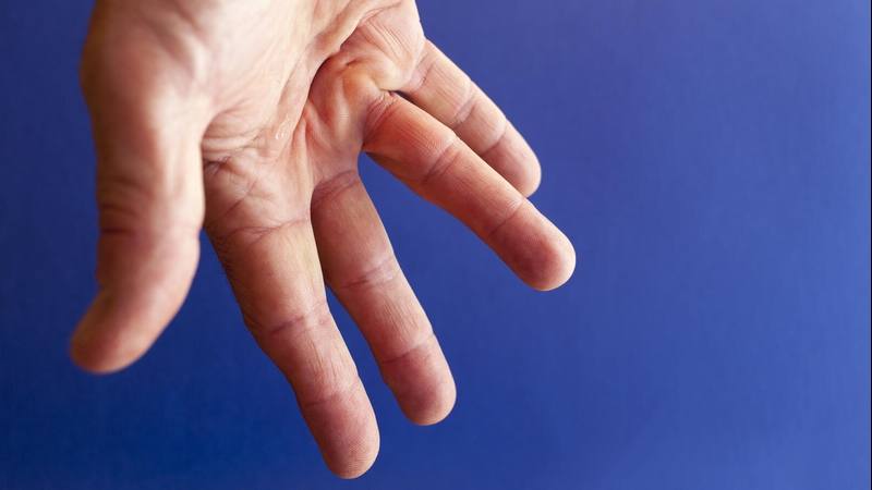 a white person's hand with Dupuytren’s contracture, fingers tension with blue background