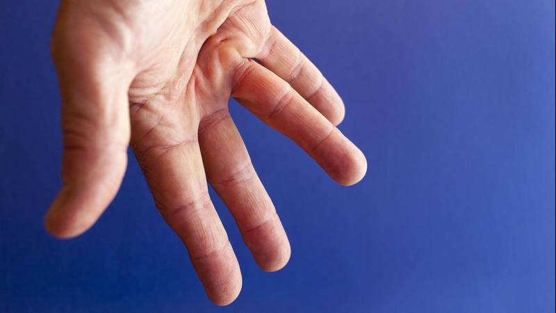 Mayo Clinic Q and A: Dupuytren's contracture - Mayo Clinic News Network