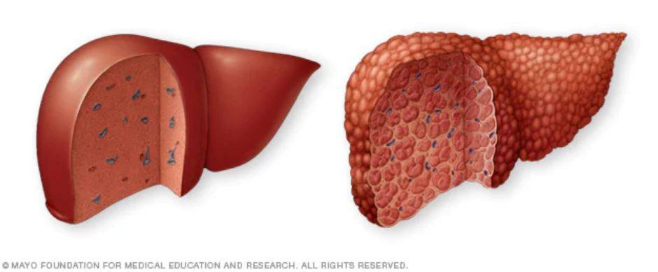 illustration of normal liver versus liver cirrhosis