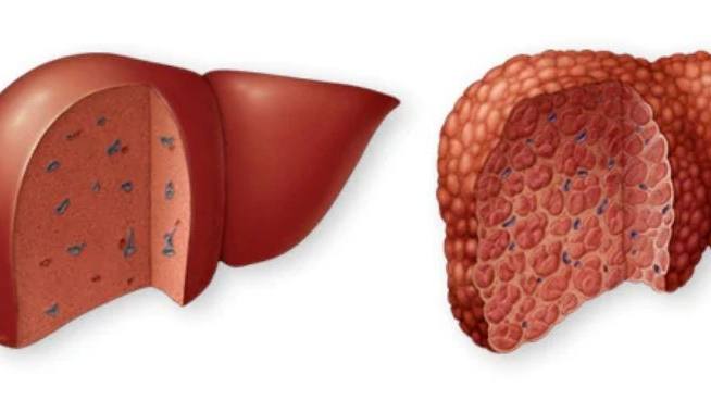 Ilustración de un hígado normal frente a otro con cirrosis