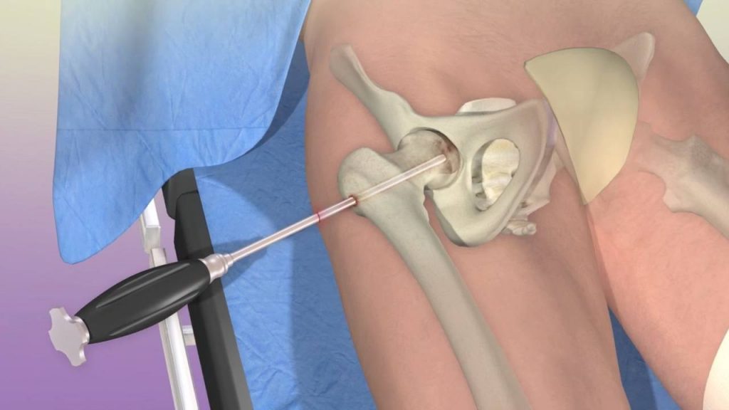 a medical illustration of hip decompression surgery for avascular hip necrosis