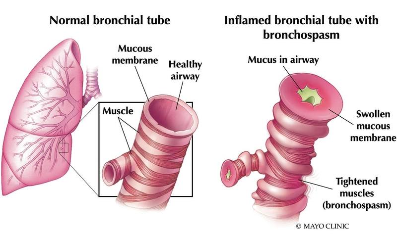 a medical illustration of a normal bronchial tube and an inflamed bronchial tube with bronchospasm