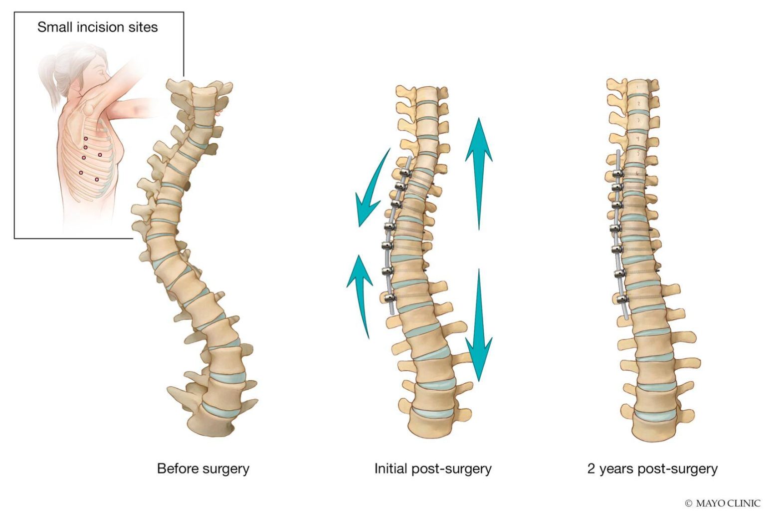 vertebral-body-tethering-another-option-for-treating-scoliosis-in