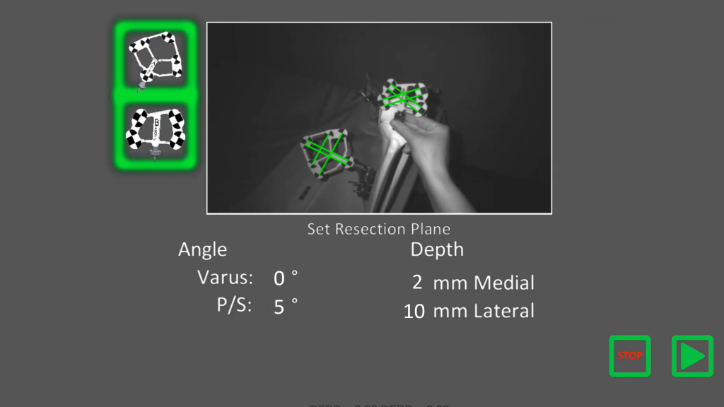 Computer image showing use of augmented reality during orthopedic surgery
