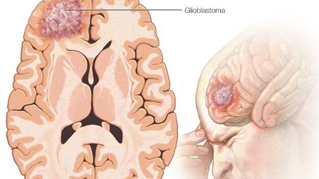 Medical illustration of glioblastoma, a type of brain tumor