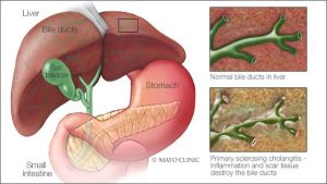 Mayo Clinic Q And A: How To Manage Symptoms Of Liver Disease - Mayo 