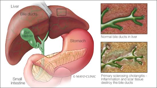 a medical illustration of primary sclerosing cholangitis