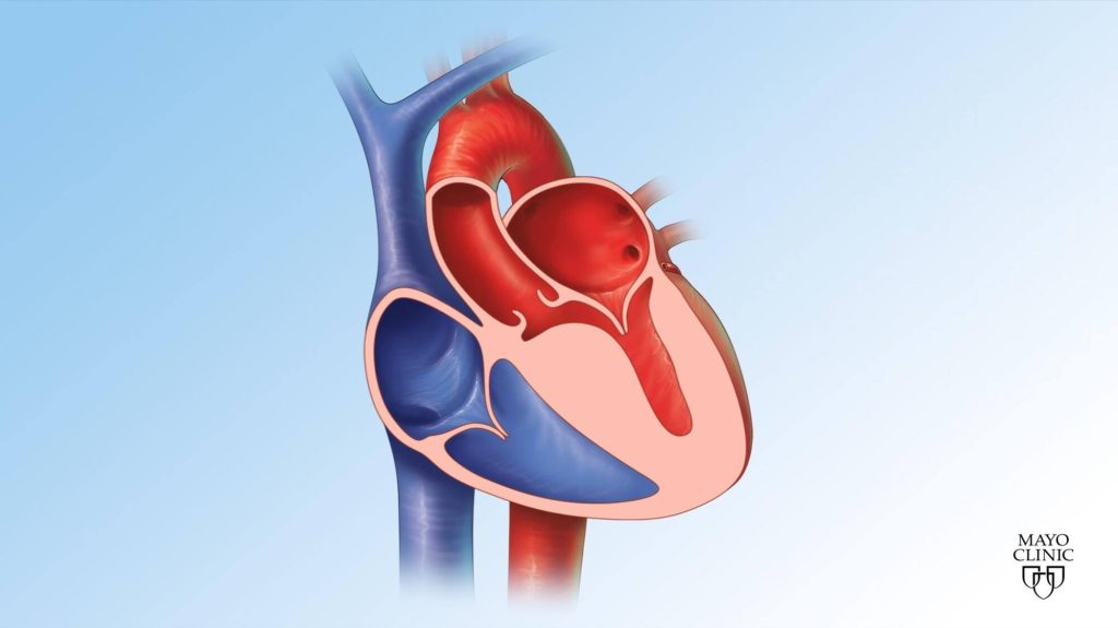 illustration of Heart with hypertrophic cardiomyopathy