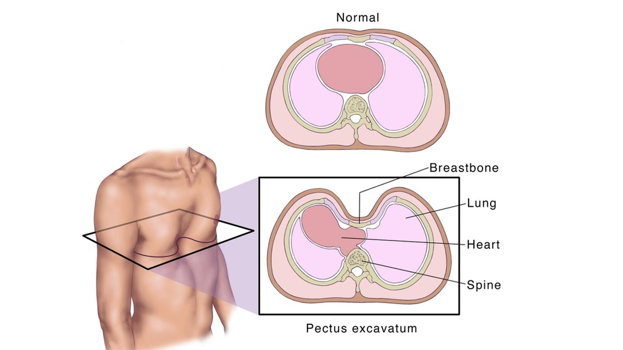 ask-the-mayo-mom-surgical-options-to-repair-pectus-excavatum-mayo