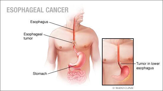 medical illustration of esophageal cancer