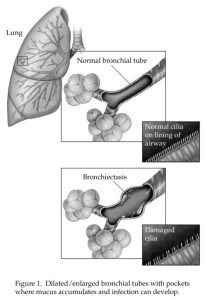 medical illustration depicting bronchiectasis
