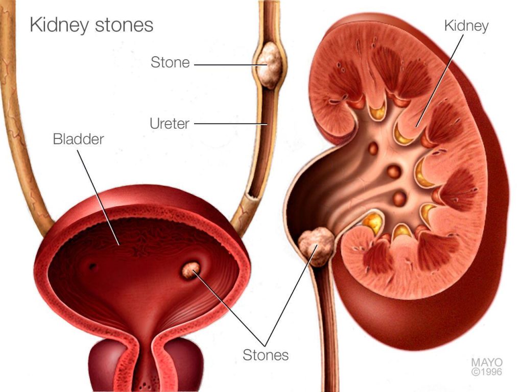 Cutaway views of the bladder, ureter and kidney with stones