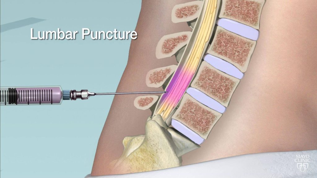 Medical illustration of lumbar puncture