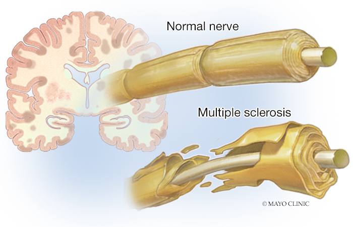 Medical illustration of normal nerve and nerve affected by MS