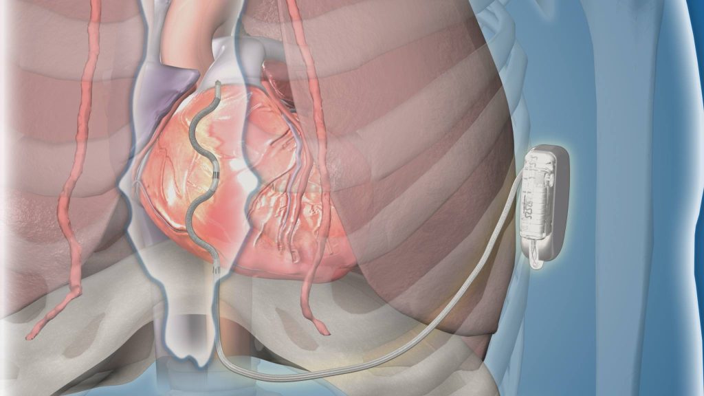 illustration of an extravascular implantable cardioverter-defibrillator (ICD) placement