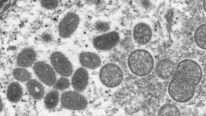 Microscopic image of monkeypox virus particles.