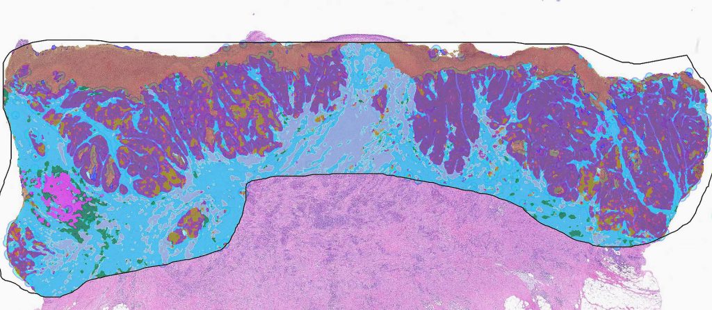QuantCRC applied to a digitized image of colorectal cancer highlighting different regions within the tumor.