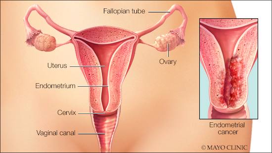 a-medical-illustration-of-endometrial-cancer