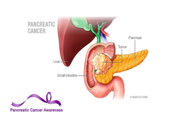 a medical illustration of pancreatic cancer with a purple Pancreatic Cancer Awareness ribbon graphic