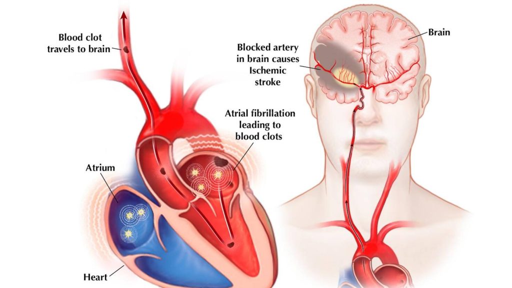 Atrial fibrillation can lead to the development of blood clots in the heart that can break off, travel to and block arteries supplying the brain with blood. This can result in the most common type of stroke (ischemic stroke