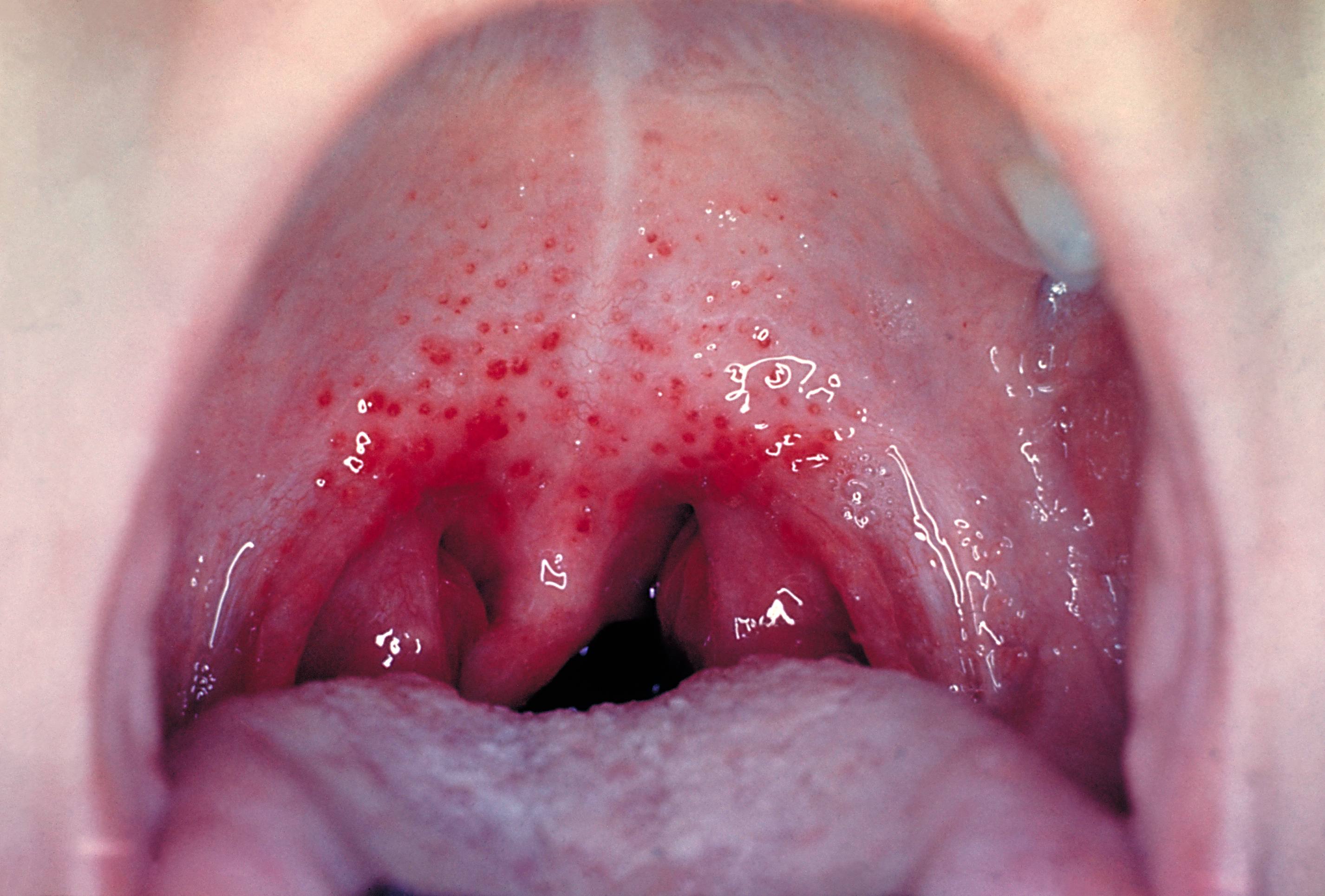 white spots on tonsils not strep