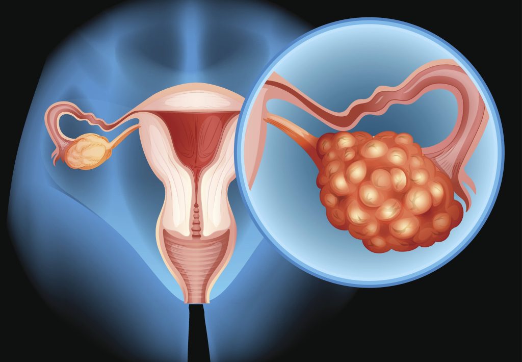 illustration of ovarian cancer
