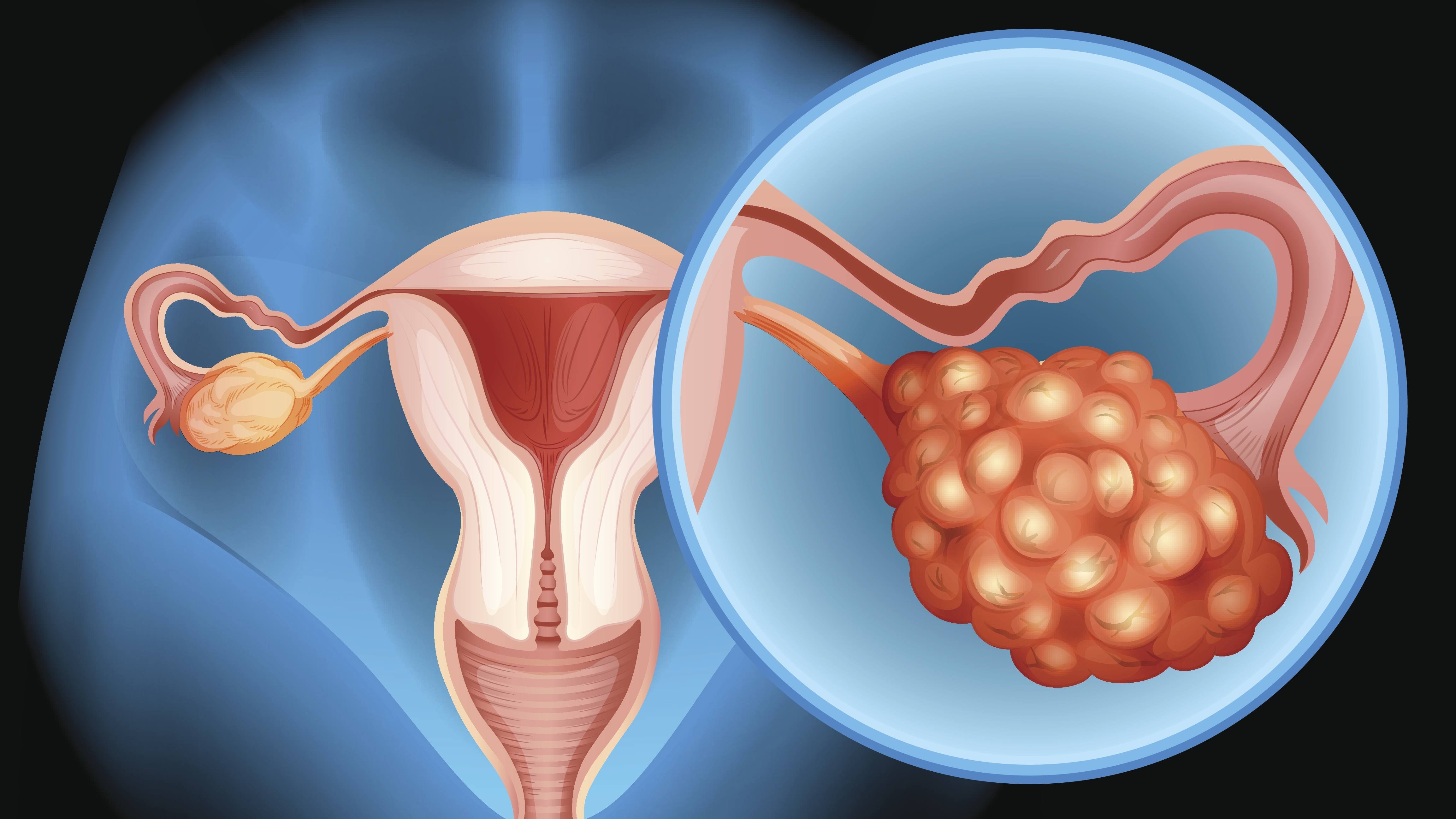 Mayo Clinic researchers link ovarian cancer to bacteria colonization in microbiome  featured image