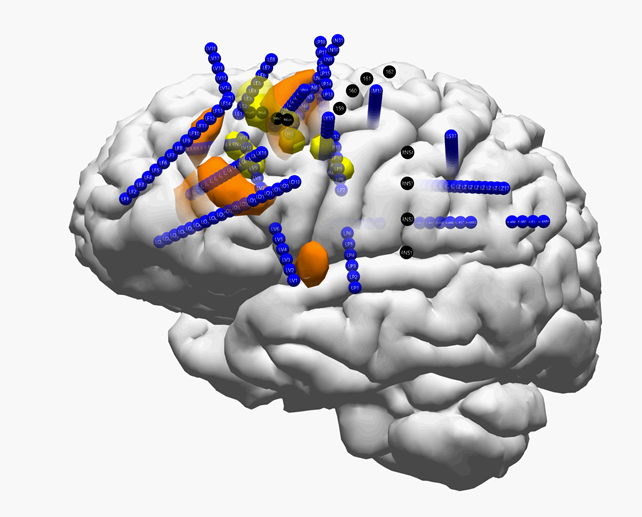 Brain mapping of seizure activity