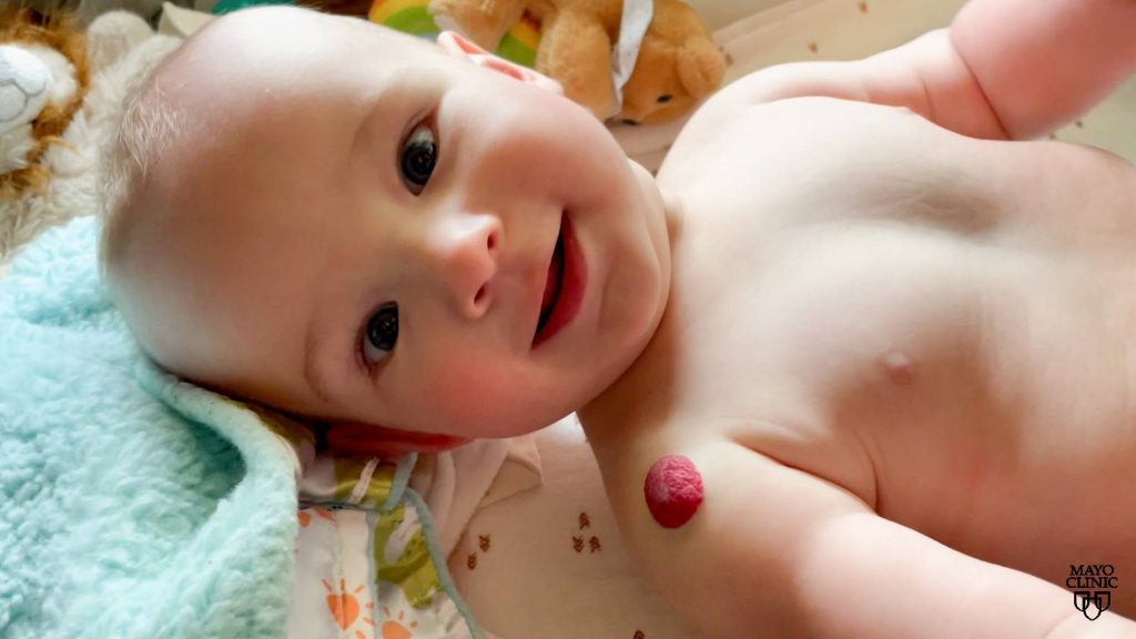 Infant with a red hemangioma on the right shoulder
