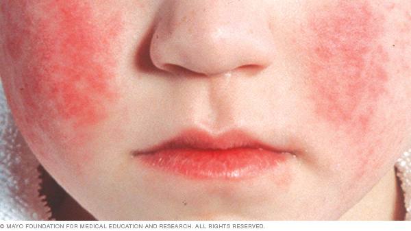 Image of a child with a bright red facial rash, indicating parvovirus B19 infection.