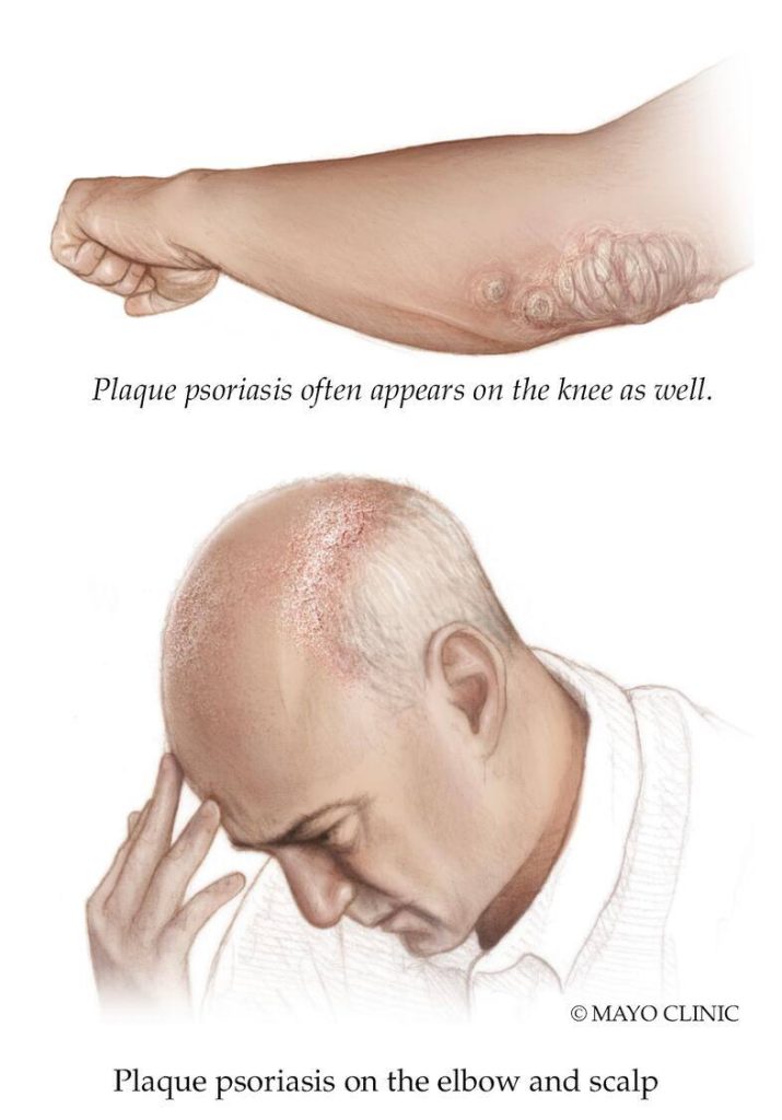 Medical illustration of man with psoriasis on elbow and scalp