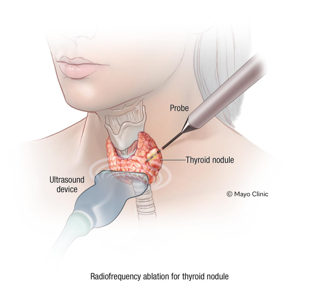 Radiofrequency ablation thyroid medical illustration (RFA)