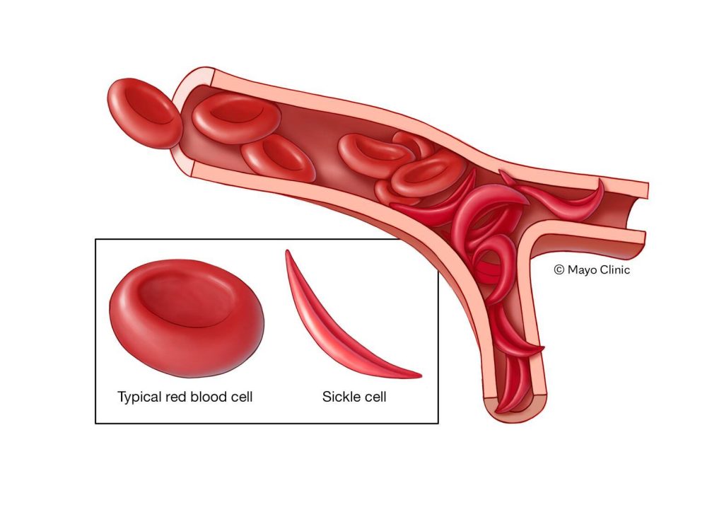Medical illustration of sickle cell next to red cell
