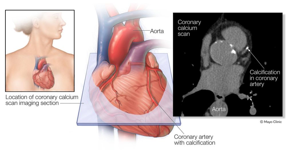 The image on the left shows where the heart is typically located in the body (A). The middle image shows the area of the coronary calcium scan image (B). The image on the right shows a coronary calcium scan (C).