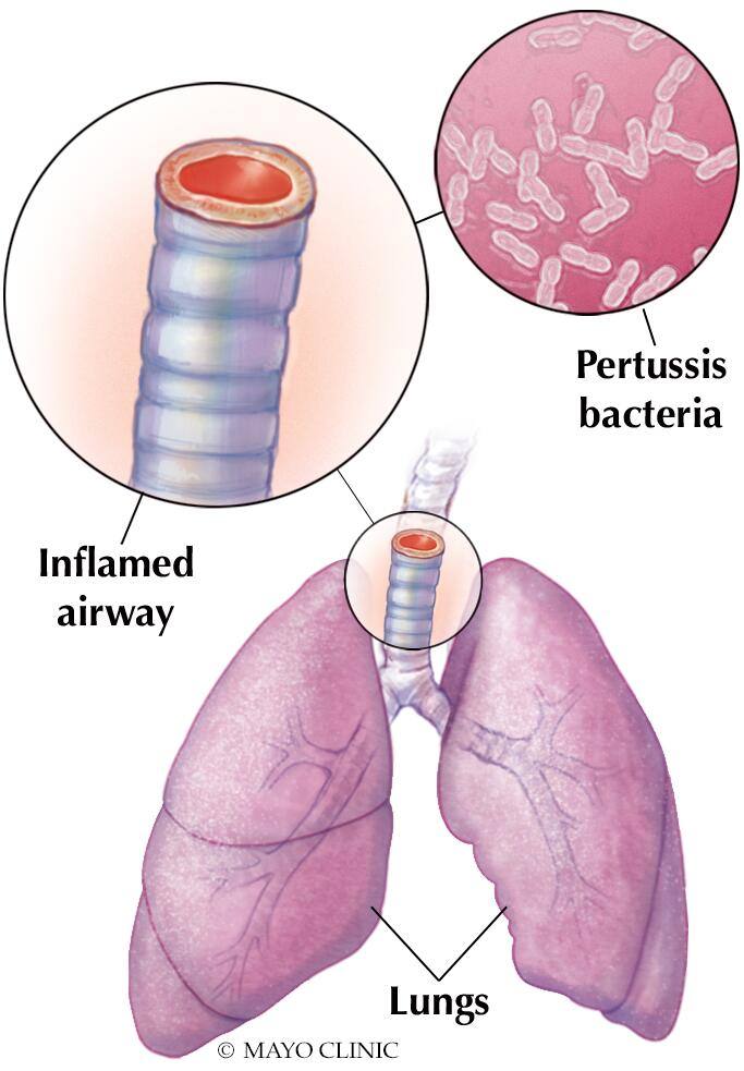 Meidical illustration, Pertussis bacteria produce toxins that inflame the airway