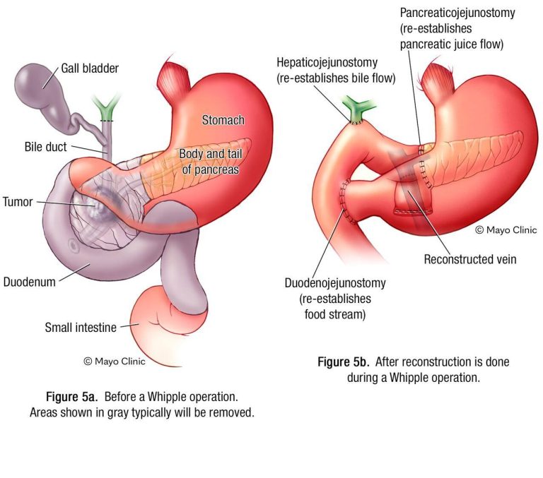 Mayo Clinic Minute: Advancing Pancreatic Cancer Treatment With Total 