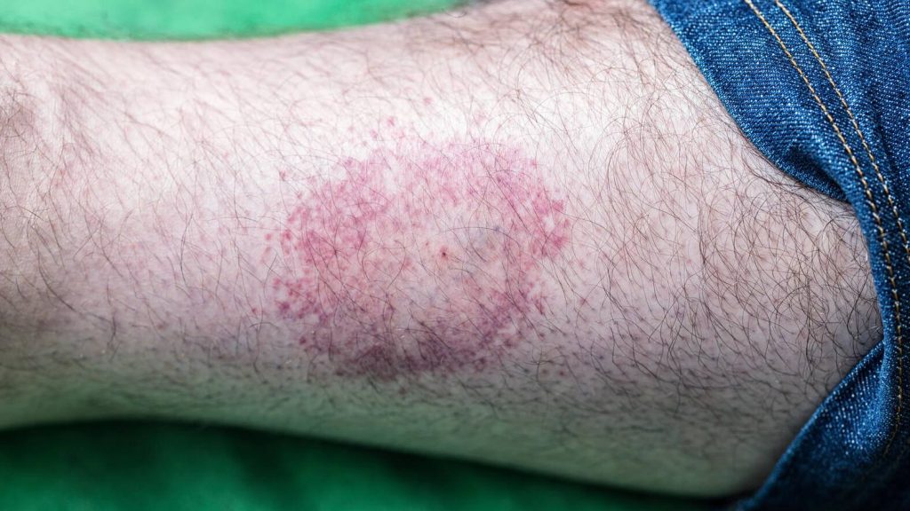 Lyme disease rash on male arm - caused by a deer tick