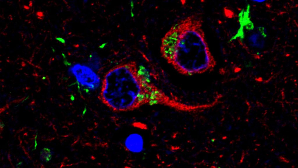 Microscopy image of TMEM106B with protein in green, cell nuclei in blue and neurons in red.