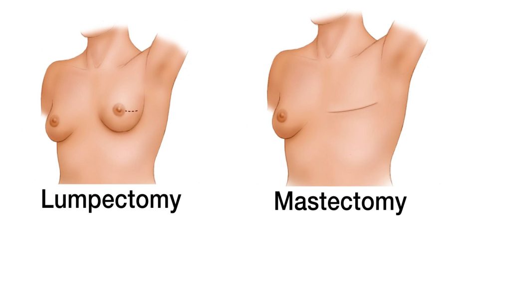 Illustration of lumpectomy and mastectomy, treatments for breast cancer 