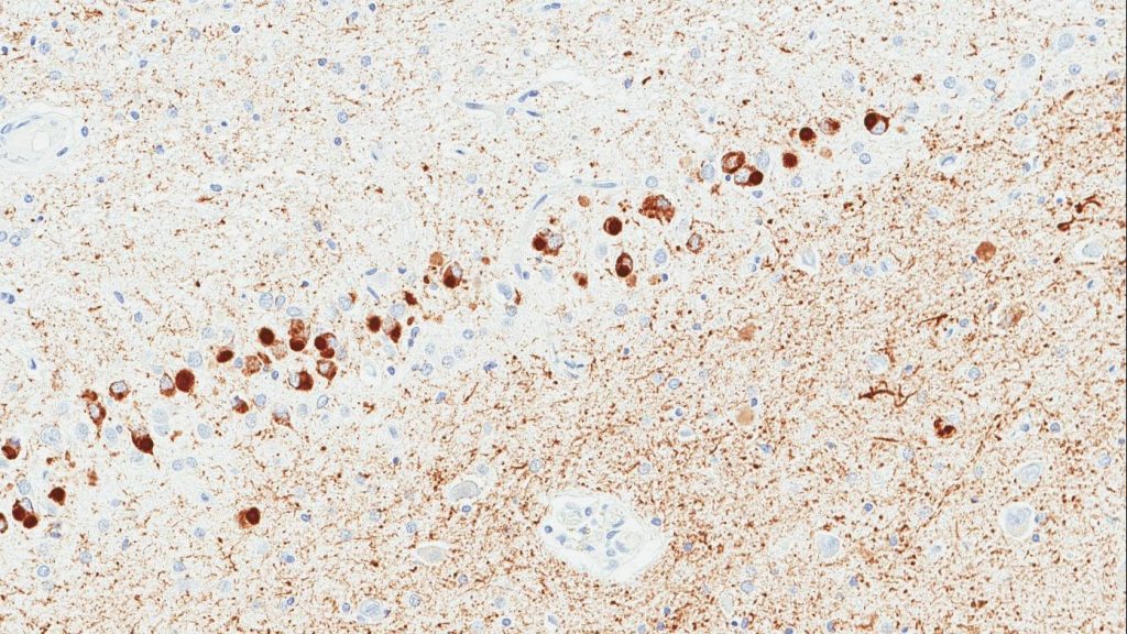 Global consortium to study Pick's disease, rare form of earlyonset