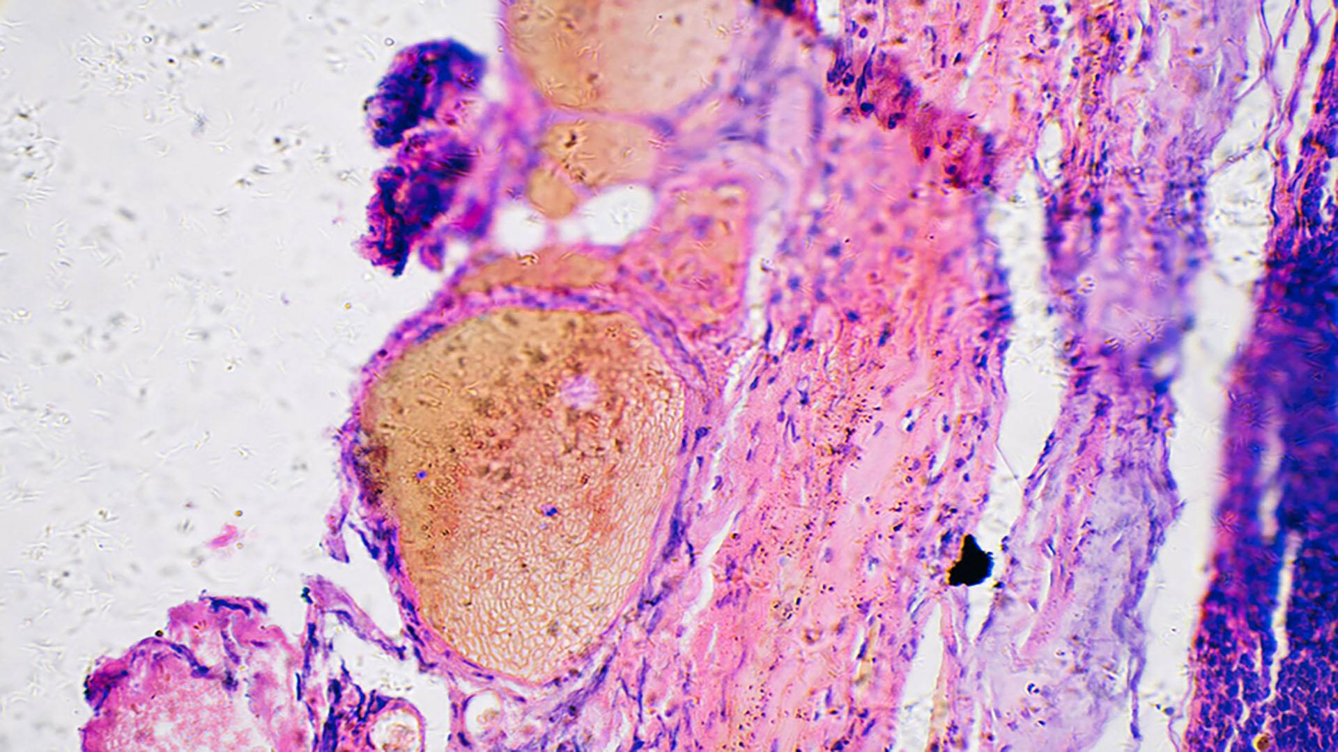 بیوپسی سلول های سرطانی ملانوما در زیر میکروسکوپ.  سلول ها برای کنتراست بیشتر رنگ می شوند.