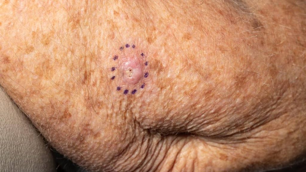 Photograph of squamous cell carcinoma on elbow