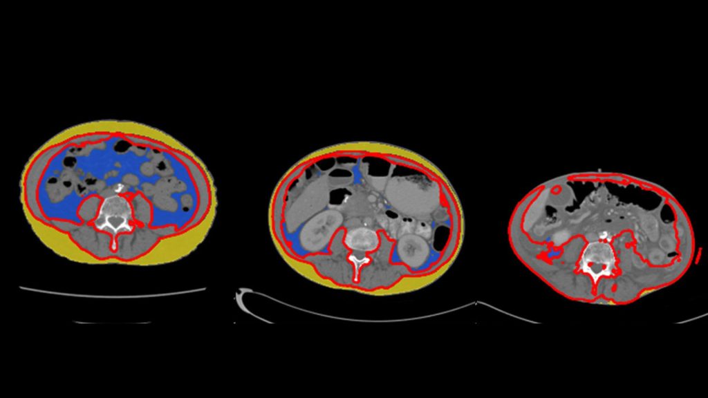 Abdominal CT scans in the same individual prior to diagnosis of pancreatic cancer shows profound changes in body composition from 14 months and nine months prior to cancer diagnosis.