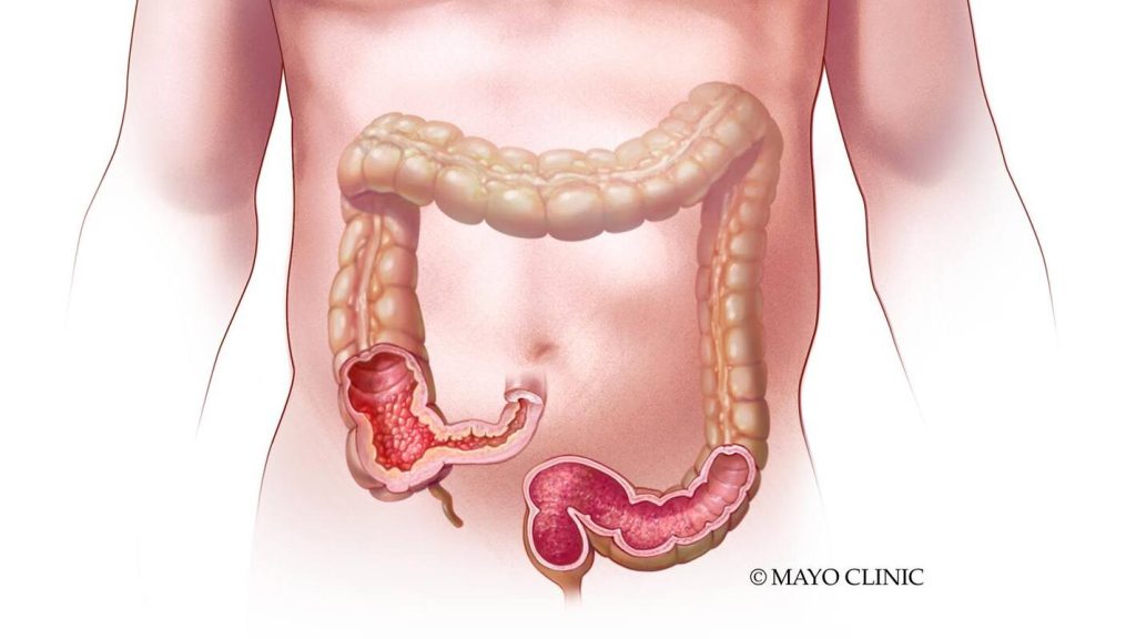 Medical illustration of ulcerative colitis and Crohn's disease, an autoimmune disorder