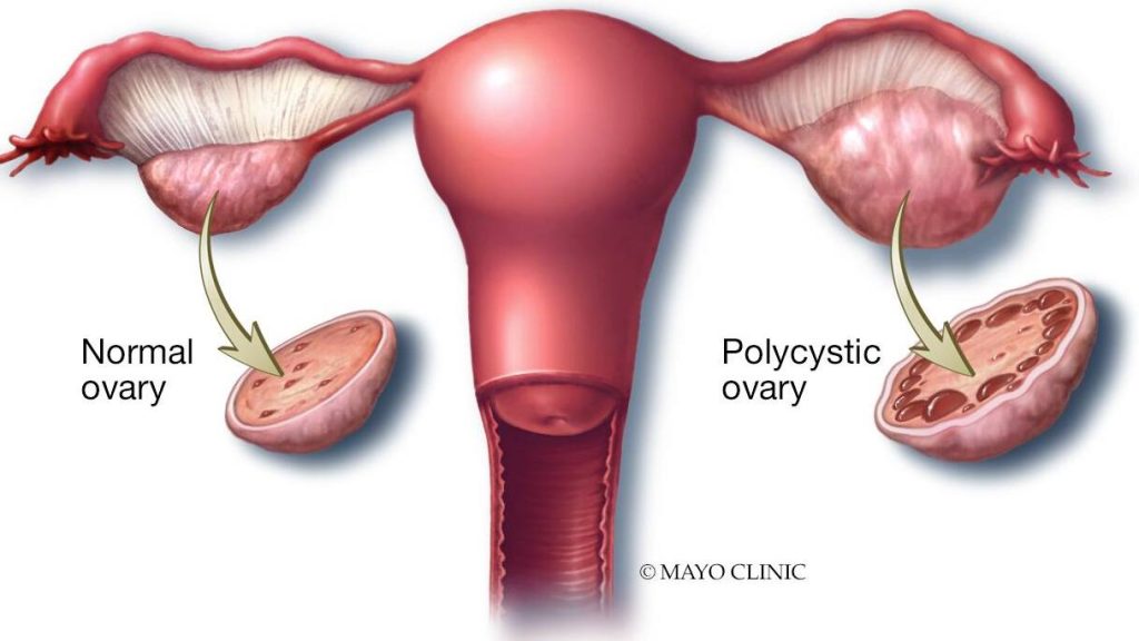 Medical illustration of normal ovary and one a polycystic ovary