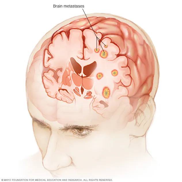 Medical illustration of brain metastases