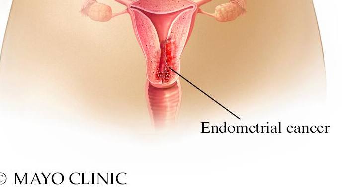 Medical illustration of endometrial cancer