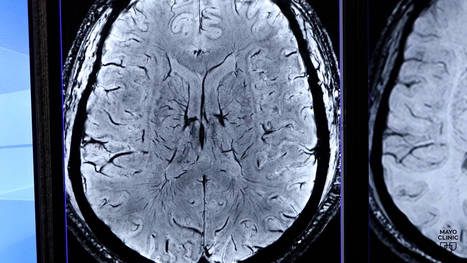 Mayo Clinic Minute: Understanding brain aneurysms and treatment options (VIDEO) featured image